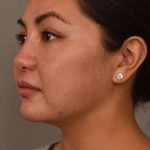 Neck Liposuction / Chin Liposuction Before & After Patient #1781
