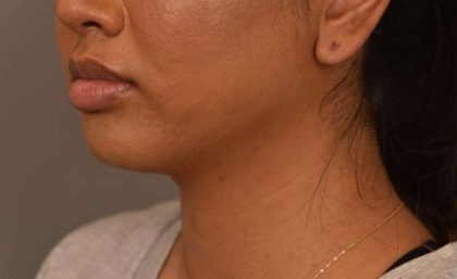 Neck Liposuction / Chin Liposuction Before & After Patient #1787