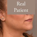 Neck Liposuction / Chin Liposuction Before & After Patient #1794