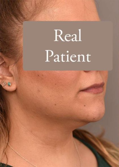 Neck Liposuction / Chin Liposuction Before & After Patient #1794