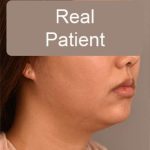 Neck Liposuction / Chin Liposuction Before & After Patient #1801