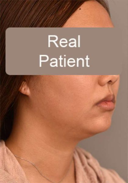 Neck Liposuction / Chin Liposuction Before & After Patient #1801