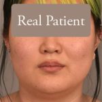 Neck Liposuction / Chin Liposuction Before & After Patient #1816