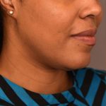 Neck Liposuction / Chin Liposuction Before & After Patient #1824