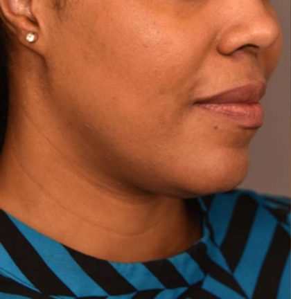 Neck Liposuction / Chin Liposuction Before & After Patient #1824