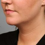 Neck Liposuction / Chin Liposuction Before & After Patient #1839