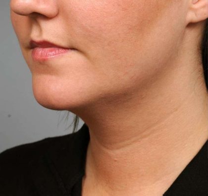 Neck Liposuction / Chin Liposuction Before & After Patient #1839