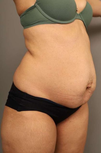 Tummy Tuck Before & After Patient #238