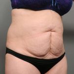 Tummy Tuck Before & After Patient #386