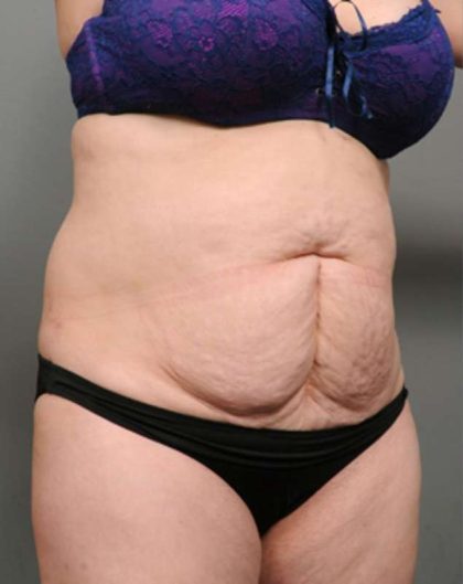 Tummy Tuck Before & After Patient #386
