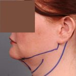 Neck Liposuction / Chin Liposuction Before & After Patient #1854