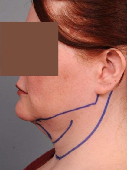 Neck Liposuction / Chin Liposuction Before & After Patient #1854
