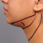 Neck Liposuction / Chin Liposuction Before & After Patient #1859