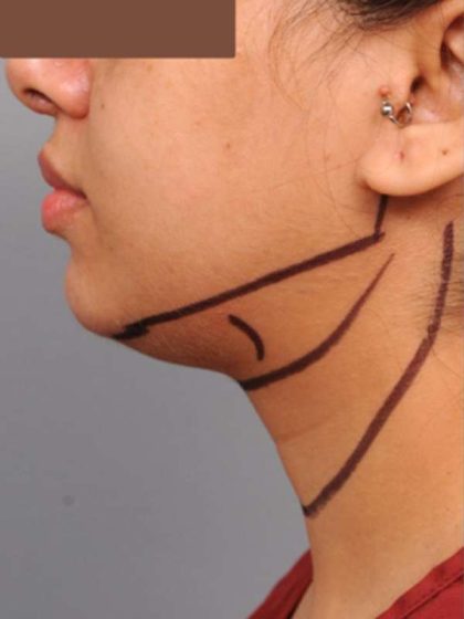 Neck Liposuction / Chin Liposuction Before & After Patient #1859