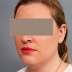 Neck Liposuction / Chin Liposuction Before & After Patient #1864