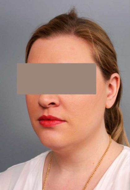 Neck Liposuction / Chin Liposuction Before & After Patient #1864