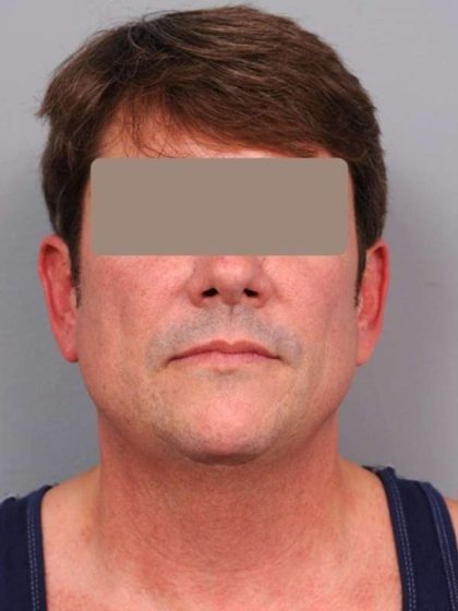Neck Liposuction / Chin Liposuction Before & After Patient #1877
