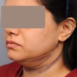 Neck Liposuction / Chin Liposuction Before & After Patient #1893