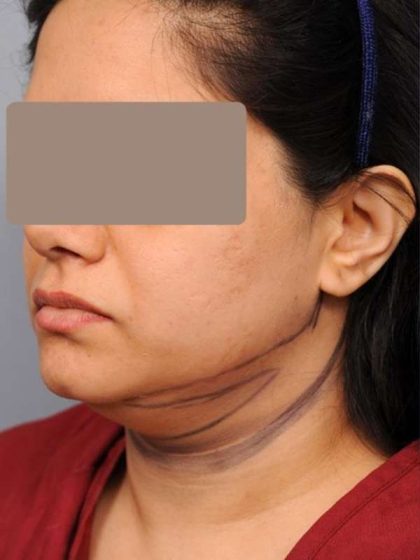 Neck Liposuction / Chin Liposuction Before & After Patient #1893