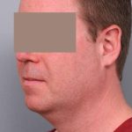 Neck Liposuction / Chin Liposuction Before & After Patient #1900