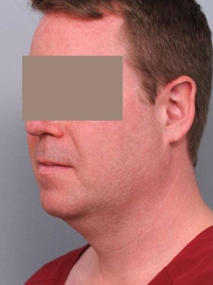 Neck Liposuction / Chin Liposuction Before & After Patient #1900