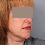 Neck Liposuction / Chin Liposuction Before & After Patient #1905