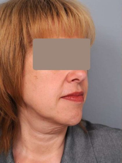 Neck Liposuction / Chin Liposuction Before & After Patient #1905