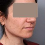Neck Liposuction / Chin Liposuction Before & After Patient #1913