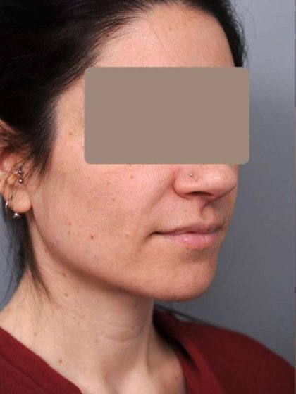 Neck Liposuction / Chin Liposuction Before & After Patient #1913