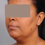 Neck Liposuction / Chin Liposuction Before & After Patient #1930