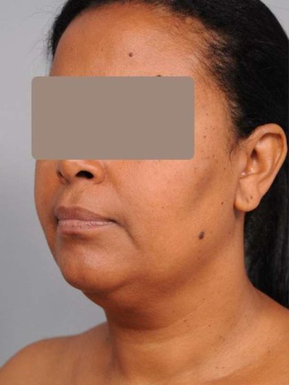 Neck Liposuction / Chin Liposuction Before & After Patient #1930