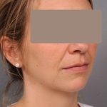 Neck Liposuction / Chin Liposuction Before & After Patient #1937