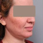 Neck Liposuction / Chin Liposuction Before & After Patient #1946