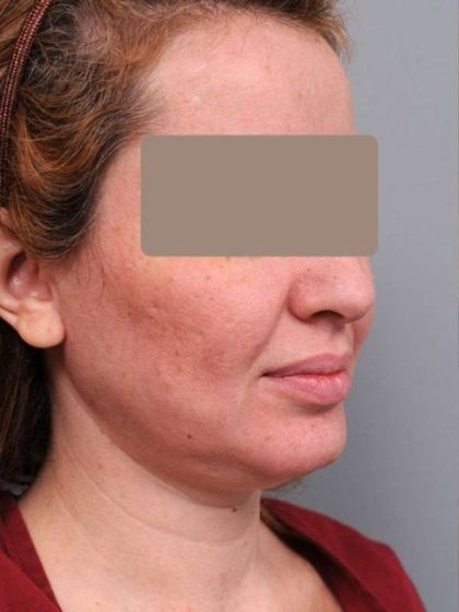 Neck Liposuction / Chin Liposuction Before & After Patient #1946