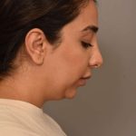 Neck Liposuction / Chin Liposuction Before & After Patient #1953