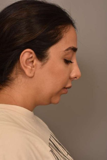 Neck Liposuction / Chin Liposuction Before & After Patient #1953
