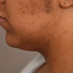 Neck Liposuction / Chin Liposuction Before & After Patient #1978