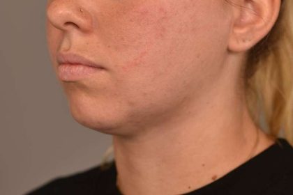 Neck Liposuction / Chin Liposuction Before & After Patient #1983