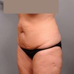 Tummy Tuck Before & After Patient #402