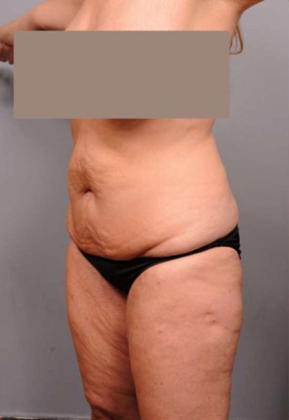 Tummy Tuck Before & After Patient #402
