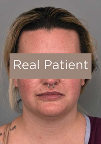 Neck Liposuction / Chin Liposuction Before & After Patient #2002