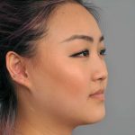 Neck Liposuction / Chin Liposuction Before & After Patient #2011