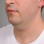 Neck Liposuction / Chin Liposuction Before & After Patient #2027