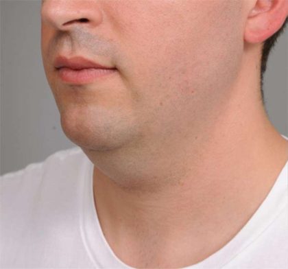 Neck Liposuction / Chin Liposuction Before & After Patient #2027
