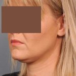 Neck Liposuction / Chin Liposuction Before & After Patient #2034