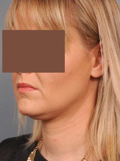 Neck Liposuction / Chin Liposuction Before & After Patient #2034