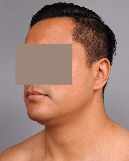 Neck Liposuction / Chin Liposuction Before & After Patient #2039