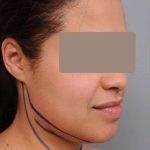 Neck Liposuction / Chin Liposuction Before & After Patient #2046