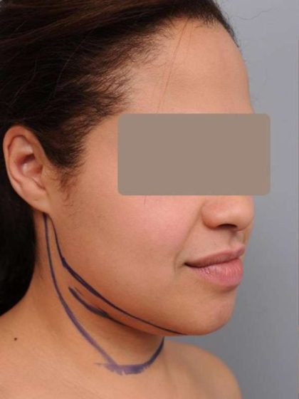 Neck Liposuction / Chin Liposuction Before & After Patient #2046