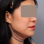 Neck Liposuction / Chin Liposuction Before & After Patient #2051